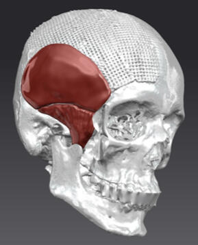 Temporal Muscle Implant Planning Patient-specific model for temporal muscle replacement with porous structure