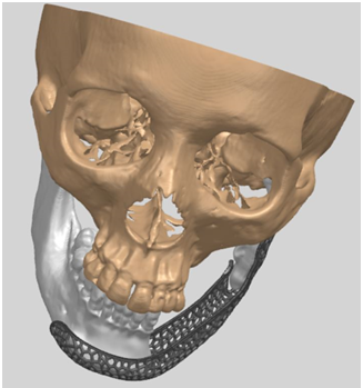 Mandibular Defect Reconstruction Personalized scaffold for mandibular bone defect regeneration and transplant placement